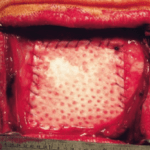 OsteoPoint™-ECM_2.2