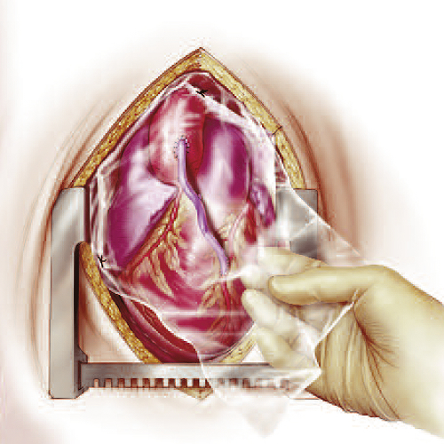 CardioWrap_2 1 CardioWrap_2 1