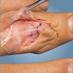 OrthoWrap®03